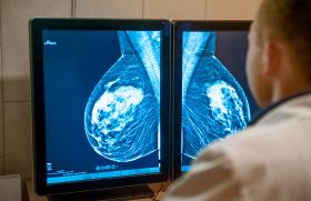 Essai monarchE et cancers du sein HR+, HER2-, à haut risque de récidive