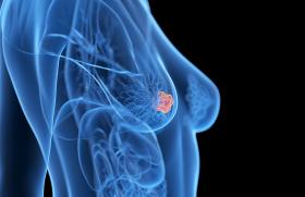 Essai I-SPY 2 et cancers du sein HER2- de haut risque