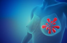 Cancers du sein métastatiques RH+ HER2-
