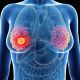 Essai de phase 3 DESTINY-Breast03