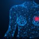 Pembrolizumab en néoadjuvant et cancers du sein triple négatifs localisés - 