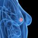 Essai I-SPY 2 et cancers du sein HER2- de haut risque