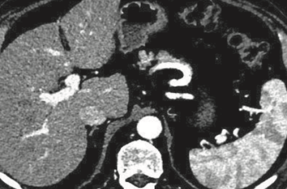 Lipiodol marqué au rhénium 188 : agent d’avenir pour la radioembolisation